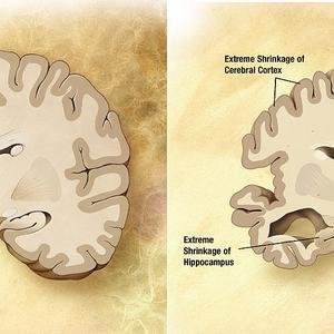 Alzheimer image
