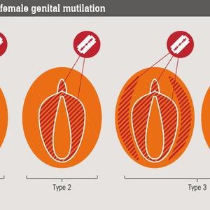 Female Genital Mutilation image